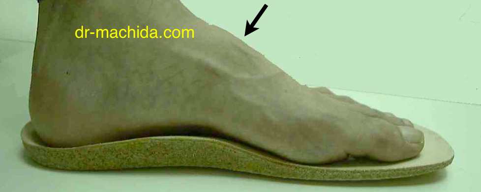 Lisfranc_insole.jpg