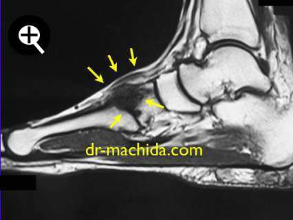 mri_Lisfranc_small.jpg