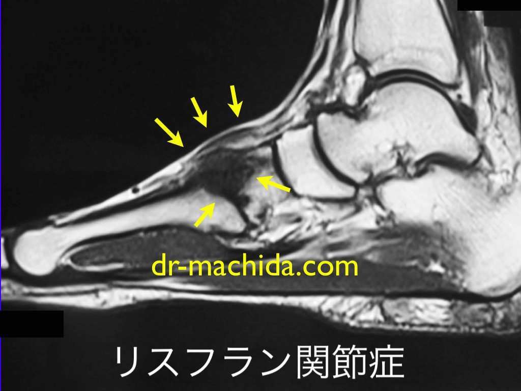 内反小趾の写真