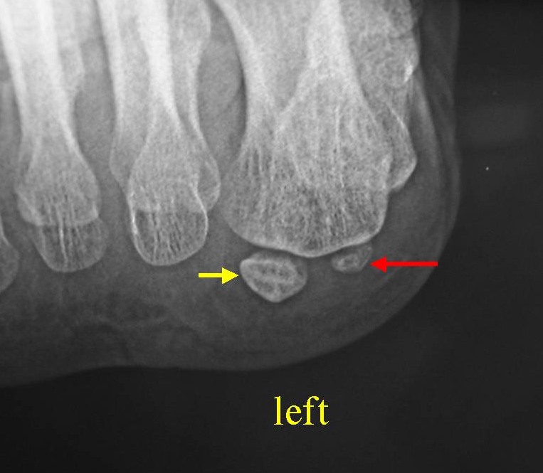 母趾種子骨の低形成 　左