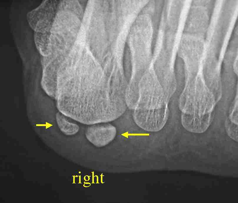 母趾種子骨の低形成 　右